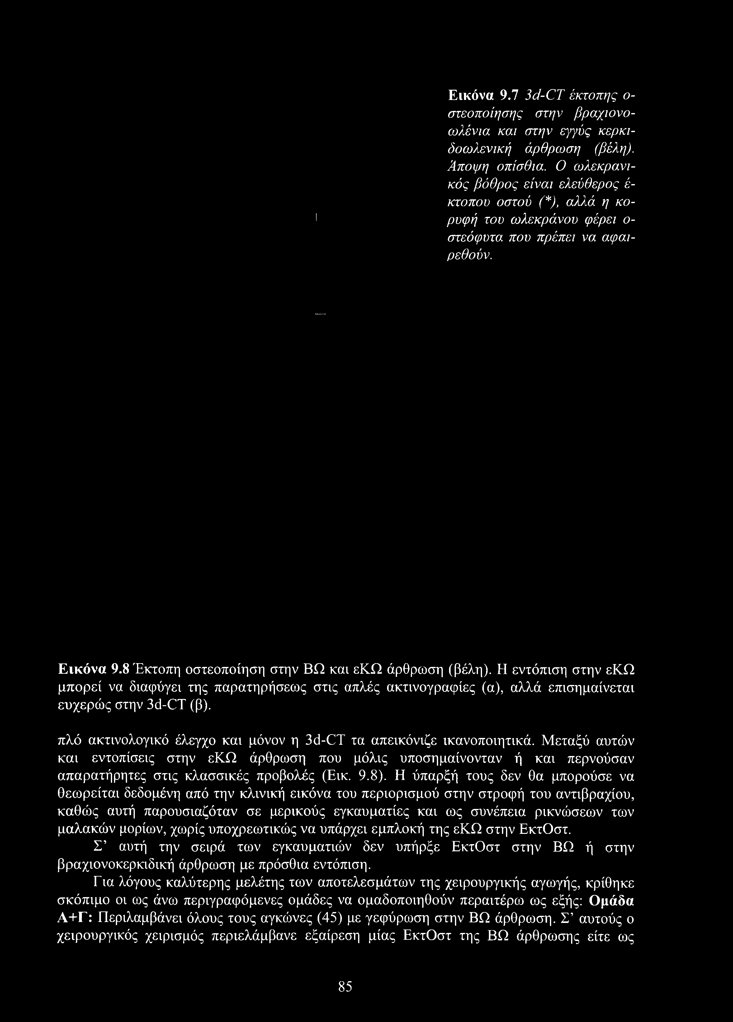 Εικόνα 9.7 3d-CT έκτοπης ο στεοποίησης στην βραχιονο- ωλένια και στην εγγύς κερκιδοωλενική άρθρωση (βέλη). Άποψη οπίσθια.