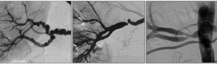 Fibromuscular dysplasia Angiographic classification Multifocal string of beads 80% cases Unifocal