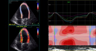 Estimation of left ventricular and atrial function by 2D speckle tracking echocardiography, in patients with different grades of severity of aortic stenosis K. Keramida, N. Kouris, V. Kostopoulos, G.