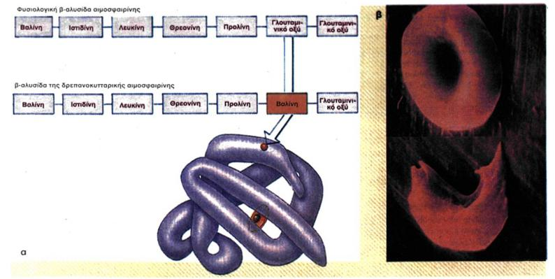 [Εικόνα 9] Η δραπανοκυτταρική αναιμία δημιουργείται από μια μετάλλαξη του γονιδίου που κωδικοποιεί τη β-πολυπεπτιδική αλυσίδα της αιμοσφαιρίνης α) στο μοντέλο του μορίου της αιμοσφαιρίνης φαίνεται η