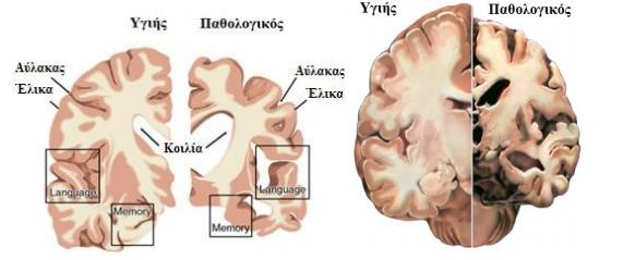 [Εικόνα 25] Μικροσκοπικά χαρακτηριστικά της νόσου Alzheimer [6.3] [Εικόνα 26] Μακροσκοπικά χαρακτηριστικά της νόσου Alzheimer [6.4,6.5]. Η ΝΑ έχει ύπουλη έναρξη και βραδεία επιδείνωση.