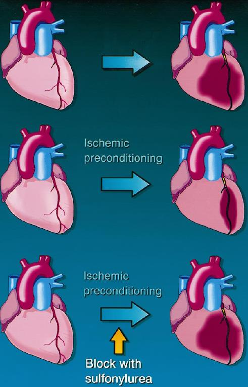 Σουλφονυλουρίες και ισχαιμική προπόνηση του μυοκαρδίου Η σταδιακή επέλευση μυοκαρδιακής ισχαιμίας προκαλεί μικρότερη βλάβη από την απότομη επέλευση.