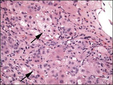 Διάγνωση ΑΙΗ Διαβρωτική νέκρωση (interface hepatitis) Επικράτηση