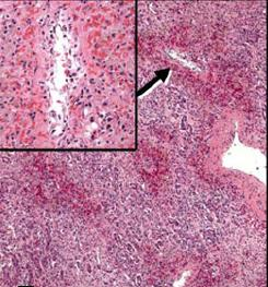 Centrilobular necroinflammatory