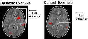 Δοκιμασία Ομοιοκαταληξίας (3/3) Οι δυσλεκτικοί εγκέφαλοι εργάζονται πιο σκληρά!