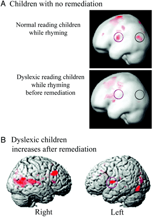 Δεξί Η Αριστερό Η Παιδιά χωρίς αποκατάσταση Ανάγνωση (με ομοιοκαταληξία) ομάδας ελέγχου Ανάγνωση (με ομοιοκαταληξία) δυσλεκτικών παιδιών πριν την αποκατάσταση Δυσλεκτικά παιδιά μετά την αποκατάσταση