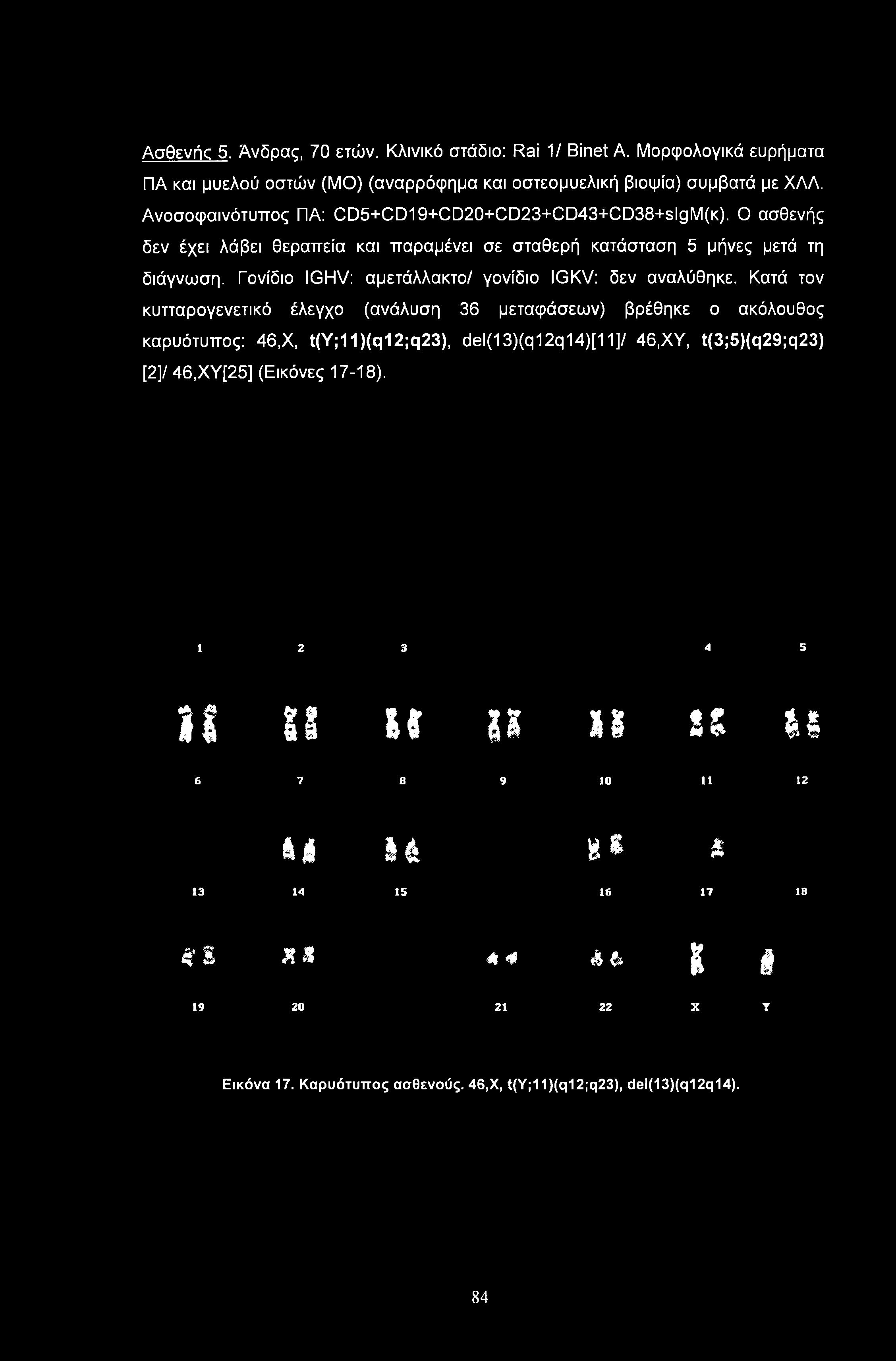 Ασθενής 5. Άνδρας, 70 ετών. Κλινικό στάδιο: Rai 1/ Binet Α. Μορφολογικά ευρήματα ΠΑ και μυελού οστών (ΜΟ) (αναρρόφημα και οστεομυελική βιοψία) συμβατά με ΧΛΛ.