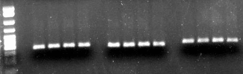 Ύφεση ιάγνωση Εικόνα 25: Real Time PT-PCR του γονιδίου VEGF στους ασθενείς µε ΟΜΛ κατά τη