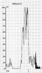 Late Potentials Abnormal electric activity due to depolarization delay may develop in areas of fibrosis and