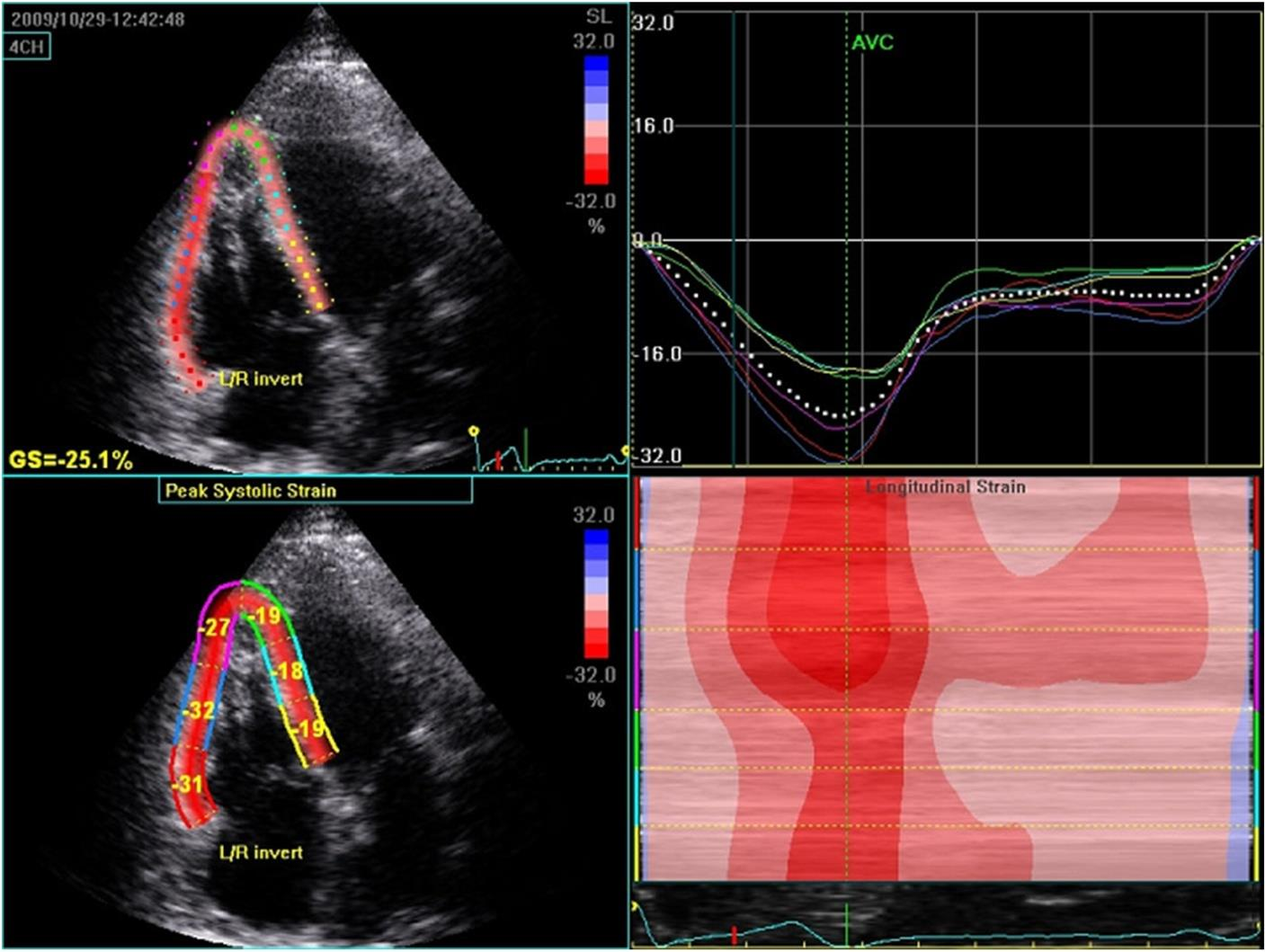 Εκτίμηση τηςδεξιάς Κοιλίας με speckle tracking echocardiography (συνολική και περιοχική) Systolic longitudinal strain was