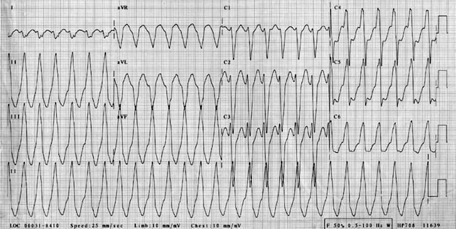 RVOT VT