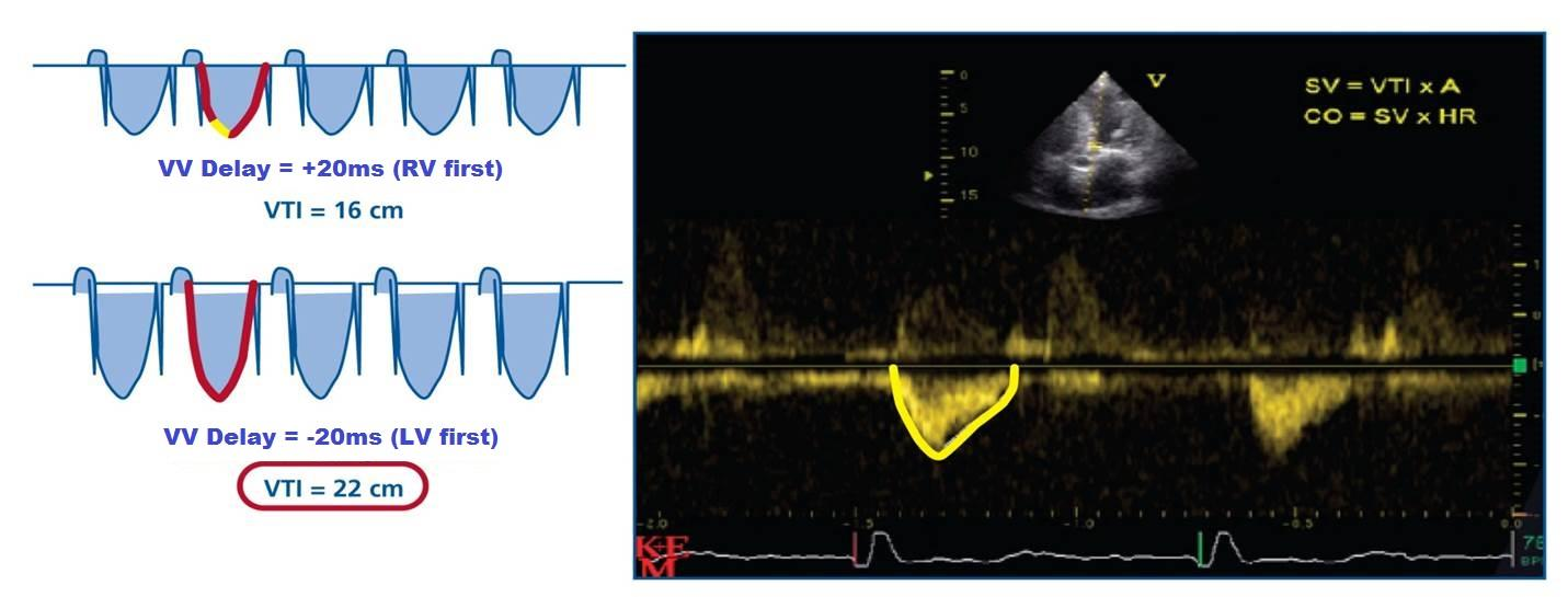 Echo Optimization of VV Delay: Aortic VTI Sinus