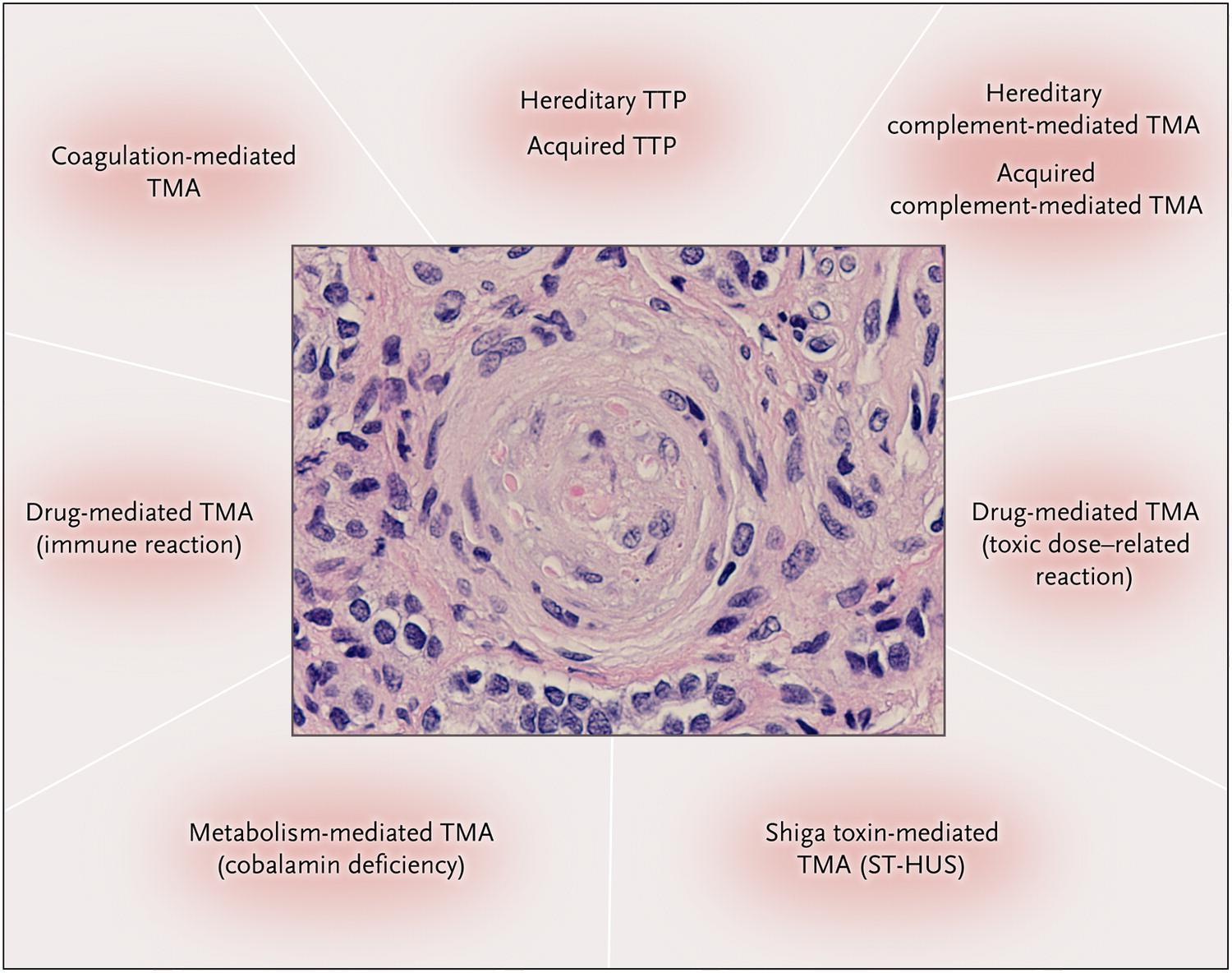 Ταξινόμηση ΤΜΑ Pathological Features of the Nine Primary Thrombotic