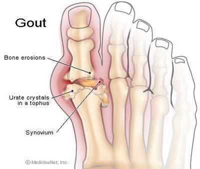 Salah satunya ialah melalui enzim terapi estetik. Ia merupakan rawatan terbaik kerana mengambil kira semua aspek yang menyumbang kepada sindrom tersebut. VITAMIN DAN GOUT Hisham merasa gelisah.