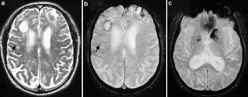 Amyloid angiopathy in a 66-year-old man with dementia.