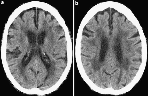 Binswanger disease in a 67-year-old man with dementia: Extensive symmetrical
