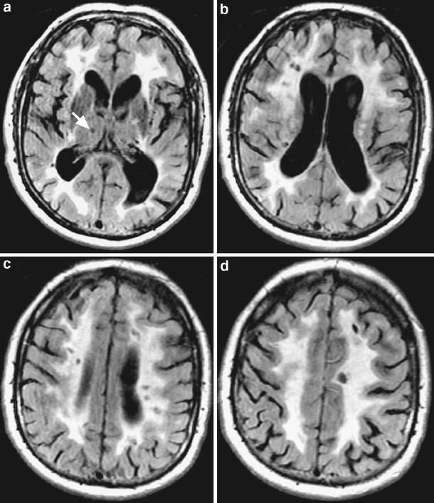 Binswanger disease in an 85-year-old man with dementia.