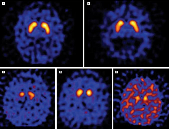Older control SPECT CIT AD O'Brien, J. T. et al.