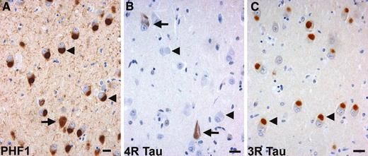 Μετωποκροταφική Ανοια - Σωμάτια Pick Pick bodies (arrowheads) and a neurofibrillary tangle (arrow) in the subiculum (a) are immunolabeled by anti-phosphorylated tau antibodies (PHF1