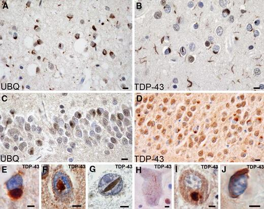 Μετωποκροταφική Ανοια / TDP - 43 Spectrum of TDP-43 pathology.