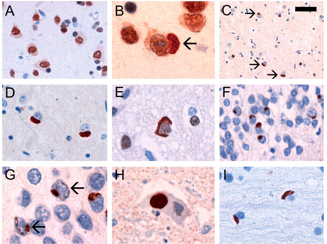 FUS staining performed on sections of post-mortem