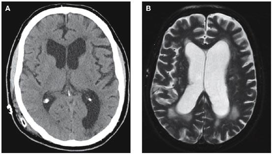 Neuroimaging of two patients with idiopathic normal pressure hydrocephalus Gallia GL et al.