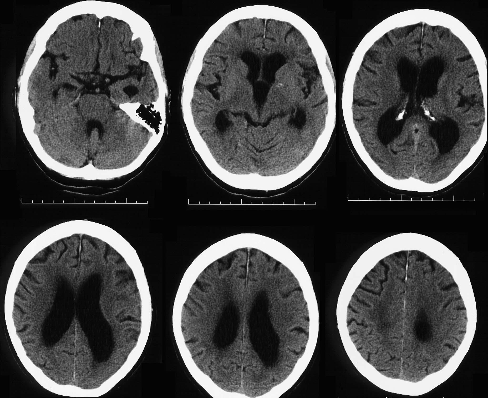 MRI: MILD