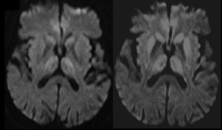 Progression of decreased diffusivity in the basal ganglia (especially the putamen),