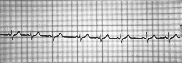 Terminológia neskorá depolarizácia - náhradný (uniklý) sťah - náhradný rytmus - nodálny (junkčný) rytmus predčasná depolarizácia -extrasystoly EKG obraz rovnaký ale!