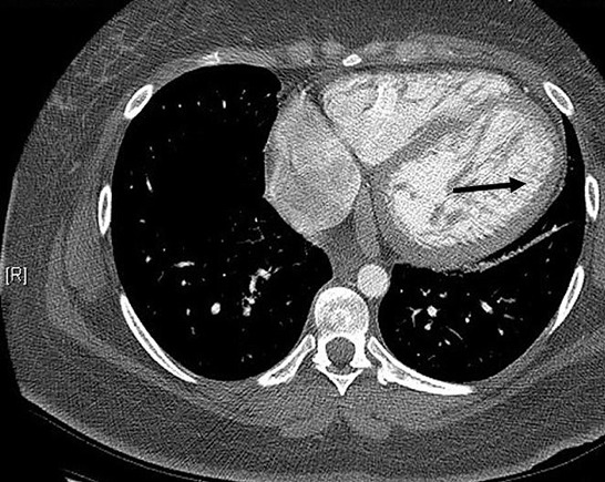 ECG gated-cardiac CT : ЗХ н хана нимгэн трабекул ихтэй, трабекулууд
