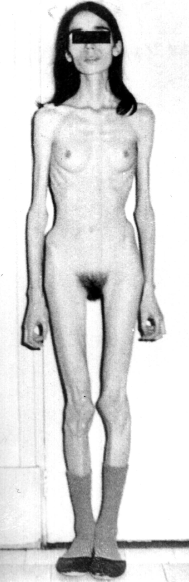 96 GINECOLOGIE ENDOCRINOLOGICĂ Fig. 29. Anorexia nervoasă.
