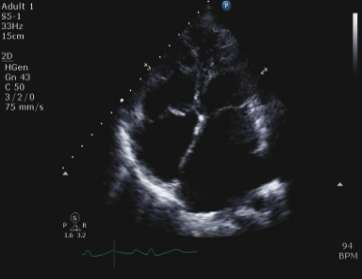 Footlike heart