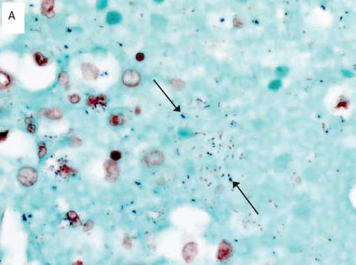Gram positive cocci with use of Lillie Twort Gram