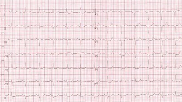 EKG ukázalo depresie ST segmentov, hlavne vo zvodoch z ľavého prekordia, čo poukazuje na nešpecifické preťaženie ľavej komory, pravdepodobne pri vzostupe krvného tlaku v artériách.