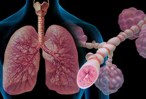 Σοβαρό άσθμα Σαν σοβαρό ορίζεται το άσθμα που απαιτεί θεραπεία με υψηλές δόσεις ICS, μαζί με ένα δεύτερο ρυθμιστικό φάρμακο ή/και συστηματικά CS προκειμένου να γίνει ελεγχόμενο ή που παραμένει μη