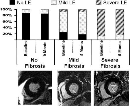 Impact of Myocardial Fibrosis in Patients With Symptomatic Severe Aortic Stenosis Οι ασθενείς με ΣΣΑ προοδευτικά αναπτύσσουν μυοκαρδιακή ίνωση που
