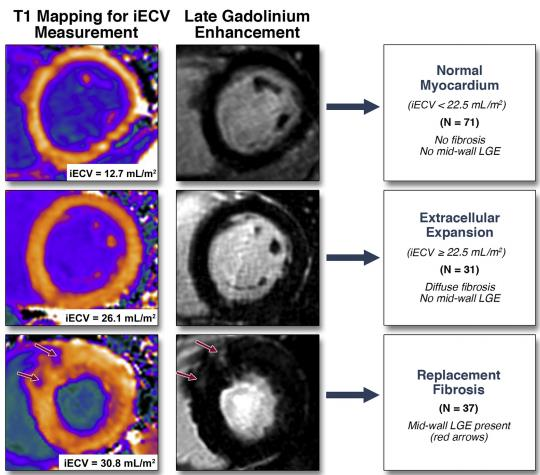 Myocardial Fibrosis and Cardiac Decompensation in Aortic Stenosis ΚΑΤΑΛΛΗΛΗ ΧΡΟΝΙΚΗ