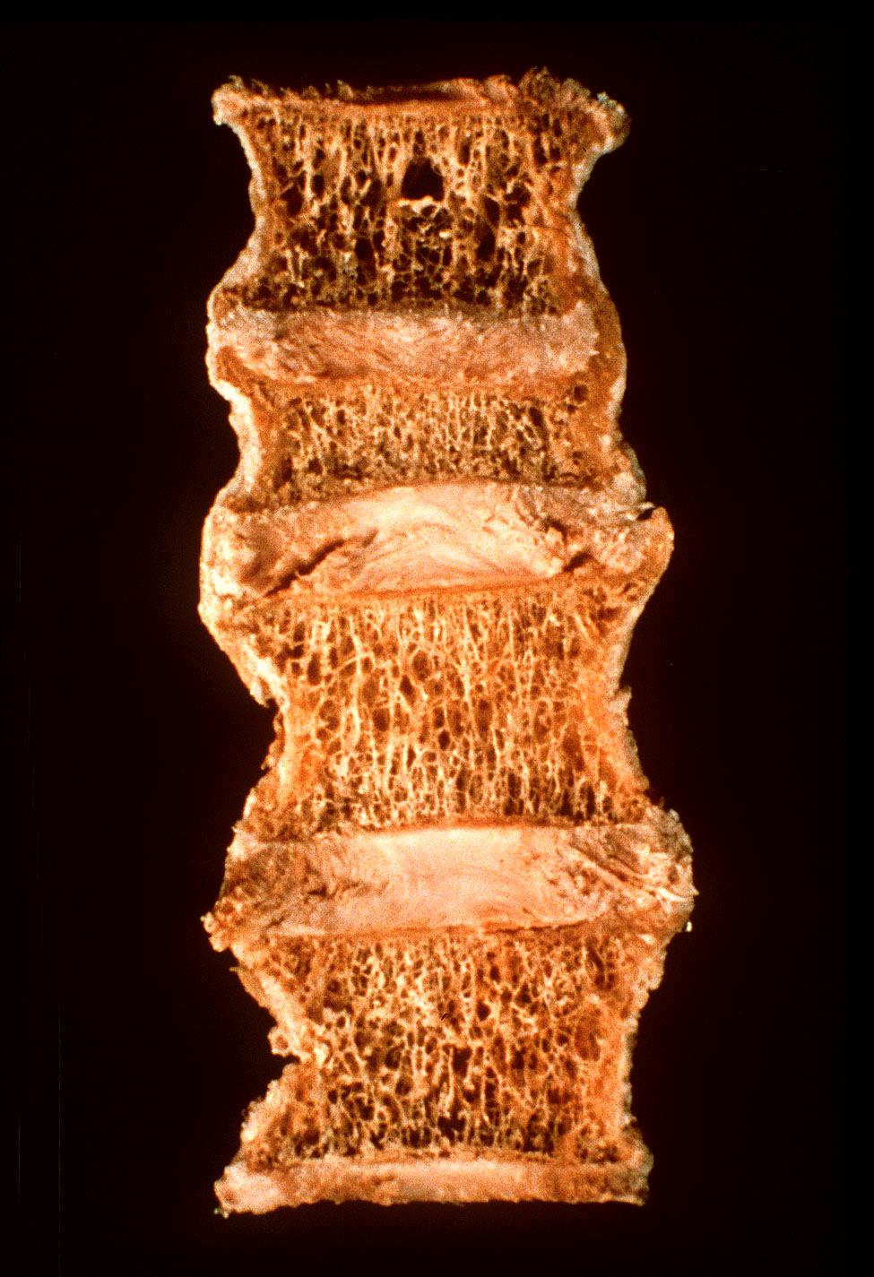 Osteoporosis Vertebral