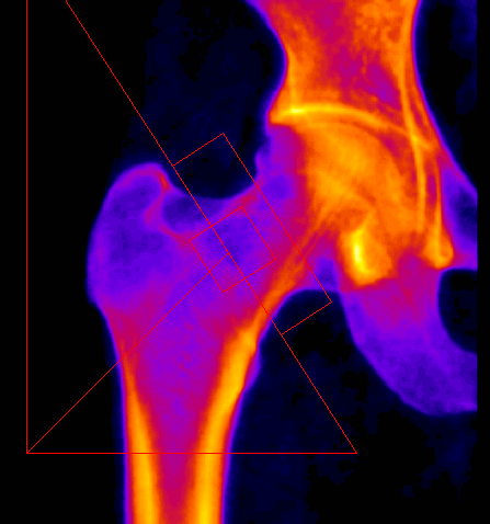 DEXA DEXA ισχίο