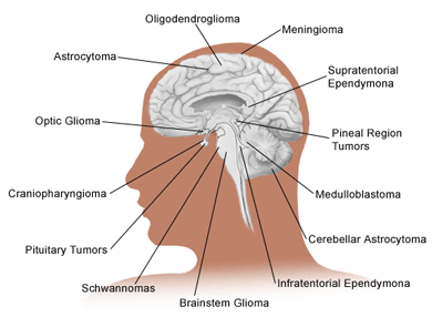 Εικόνα 20: Τύποι όγκων εγκεφάλου (Children's Hospital Boston 2005).