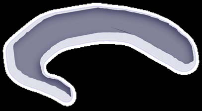 HIPPOCAMPUL CORNUL LUI AMMON