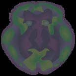 neurologice Alcoolemie 0,8 scăderea vederii laterale 1,5 Dezinhibiţie psihică, logoree,euforie
