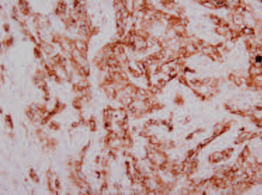 Μη Μικροκυτταρικό Καρκίνωμα Πνεύμονα θετικό στο PDL-1 (ποσοστό >70%) Από το αρχείο του παθολογοανατομικού εργαστηρίου του ΔΘΚΑ «ΥΓΕΙΑ» Η μοριακή απεικόνιση (PET/CT) στο χώρο των στοχευουσών