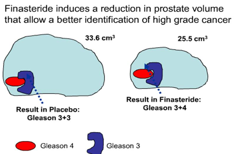 Η φιναστερίδη πιθανόν δεν επάγει όγκους υψηλής κακοήθειας αλλά μειώνοντας τον όγκο του προστάτη ( 25%)