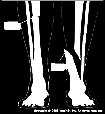 Fracture (κάταγμα) What Are Fractures? A fracture is the medical term for a broken bone. Fractures are common; the average person has two during a lifetime.