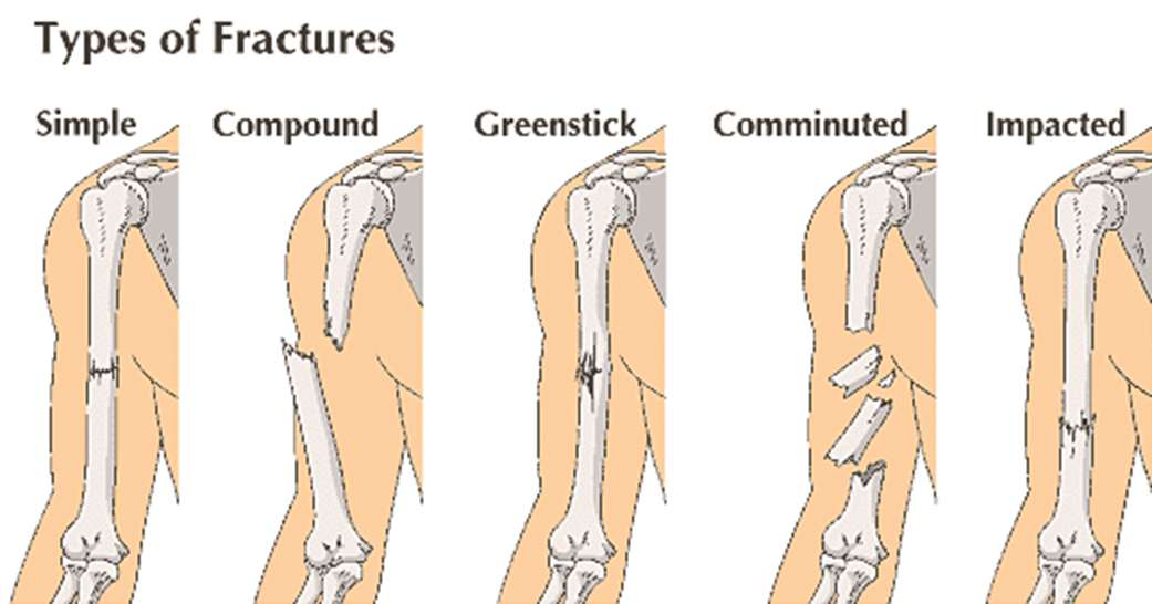 Fracture (κάταγμα) Oblique = λοξό In a displaced fracture, the bone snaps* into two or more parts and moves so that