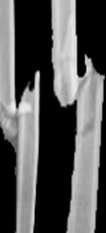 If the bone is in many pieces, it is called a comminuted (συντριπτικό) fracture.