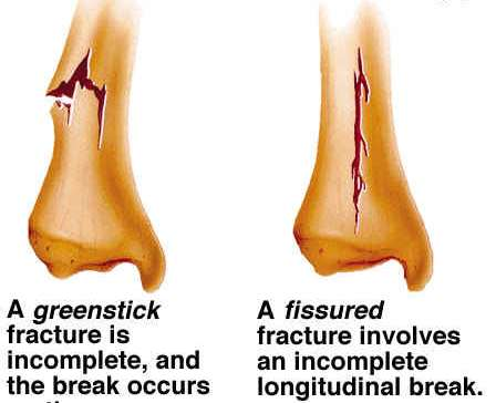 An impacted (ενσφηνωμένος) fracture is a fracture in which the bone breaks into multiple fragments which are driven
