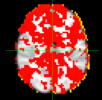 απόσταση Kullback-Leibler δεν εντοπίζει κάποιο resting-state δίκτυο του