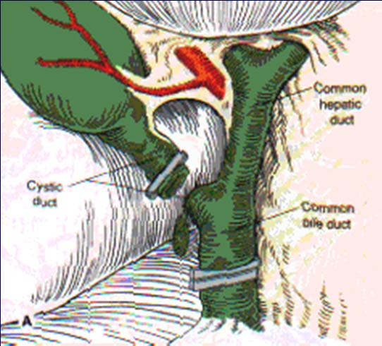 Variant bile duct injury CBD misidentified as Cystic duct despite initial dissection of Calot s triangle May occur if infundibulum is drawn anteriorly